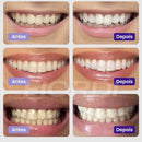 Clareador Dentário - Sérum V34™ + Brinde